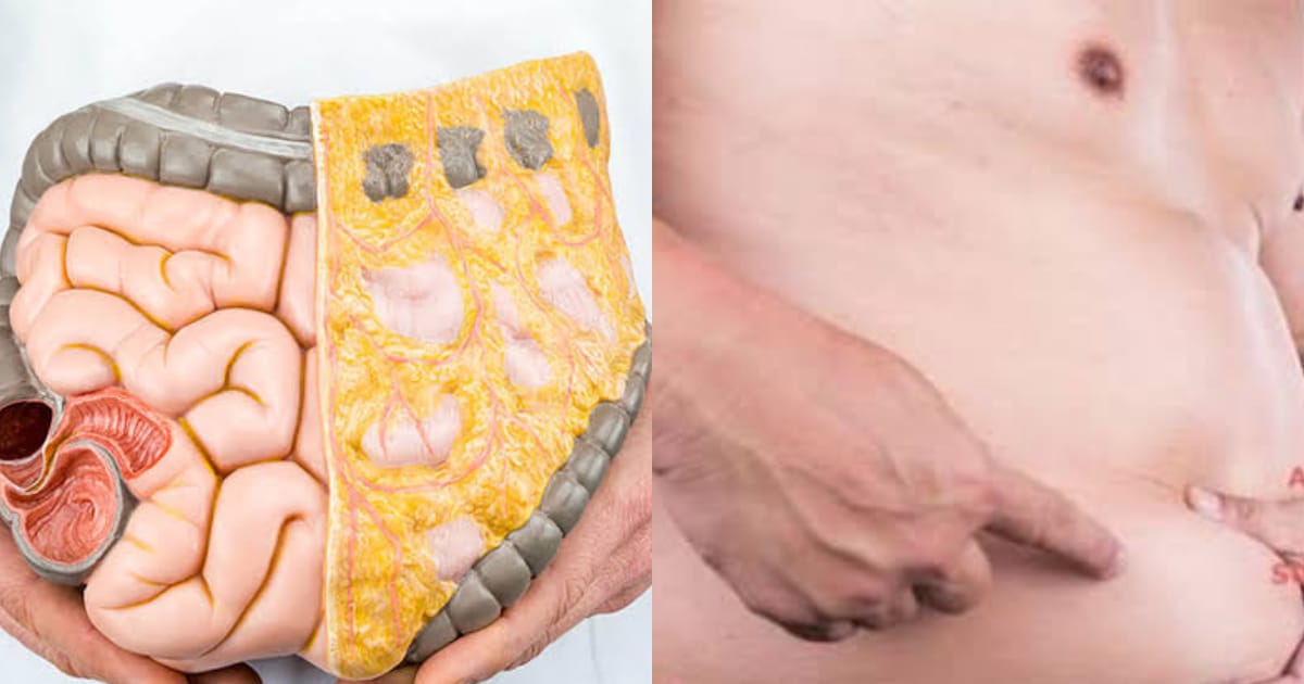 Visceral fat is a type of body that is stored within the abdominal cavity. It’s usually located near several vital organs like the Liver, Stomach, Arteries, etc.