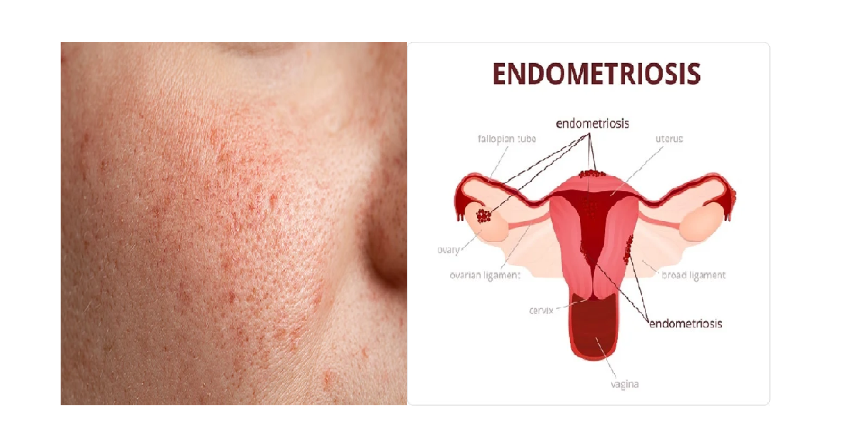 Open pores and endometriosis